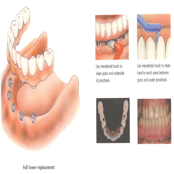  Dental Implants